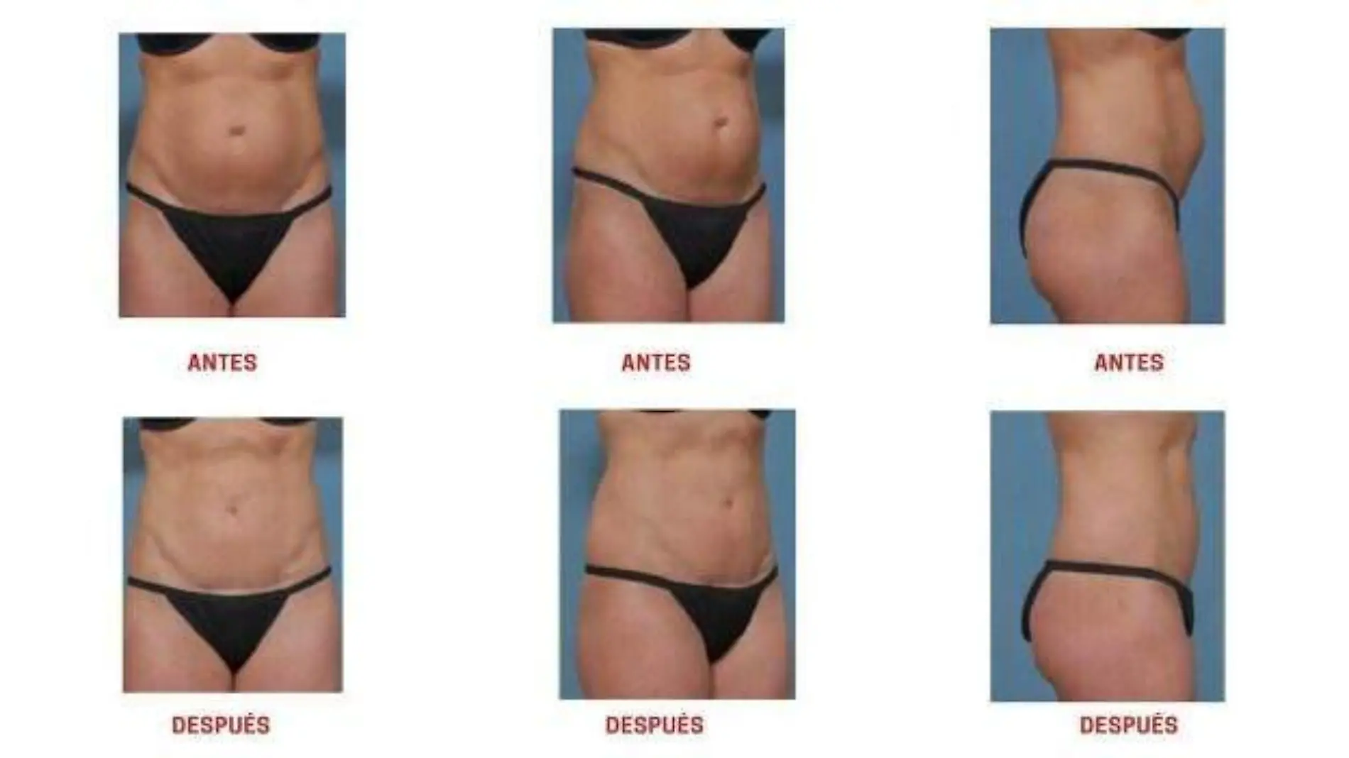 BEFORE AND AFTER ABDOMINOPLASTIA W1 WOMAN